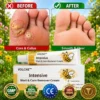 VOLCNE™ Intensive Wart & Corn Remover Cream