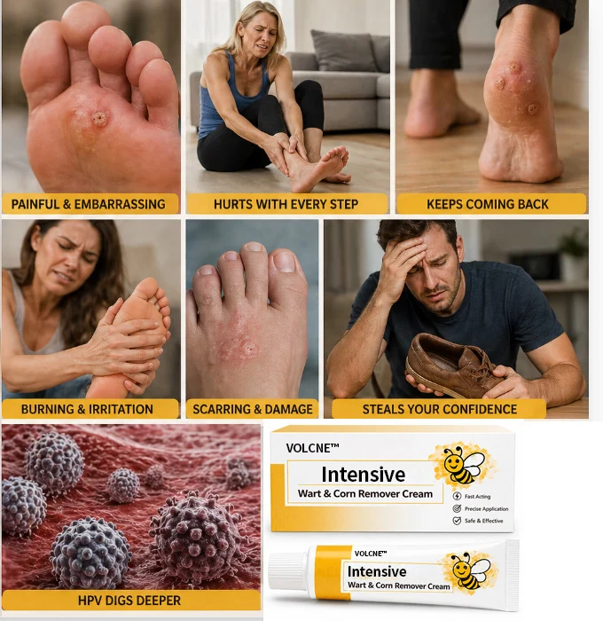 VOLCNE™ Intensive Wart & Corn Remover Cream - Image 6